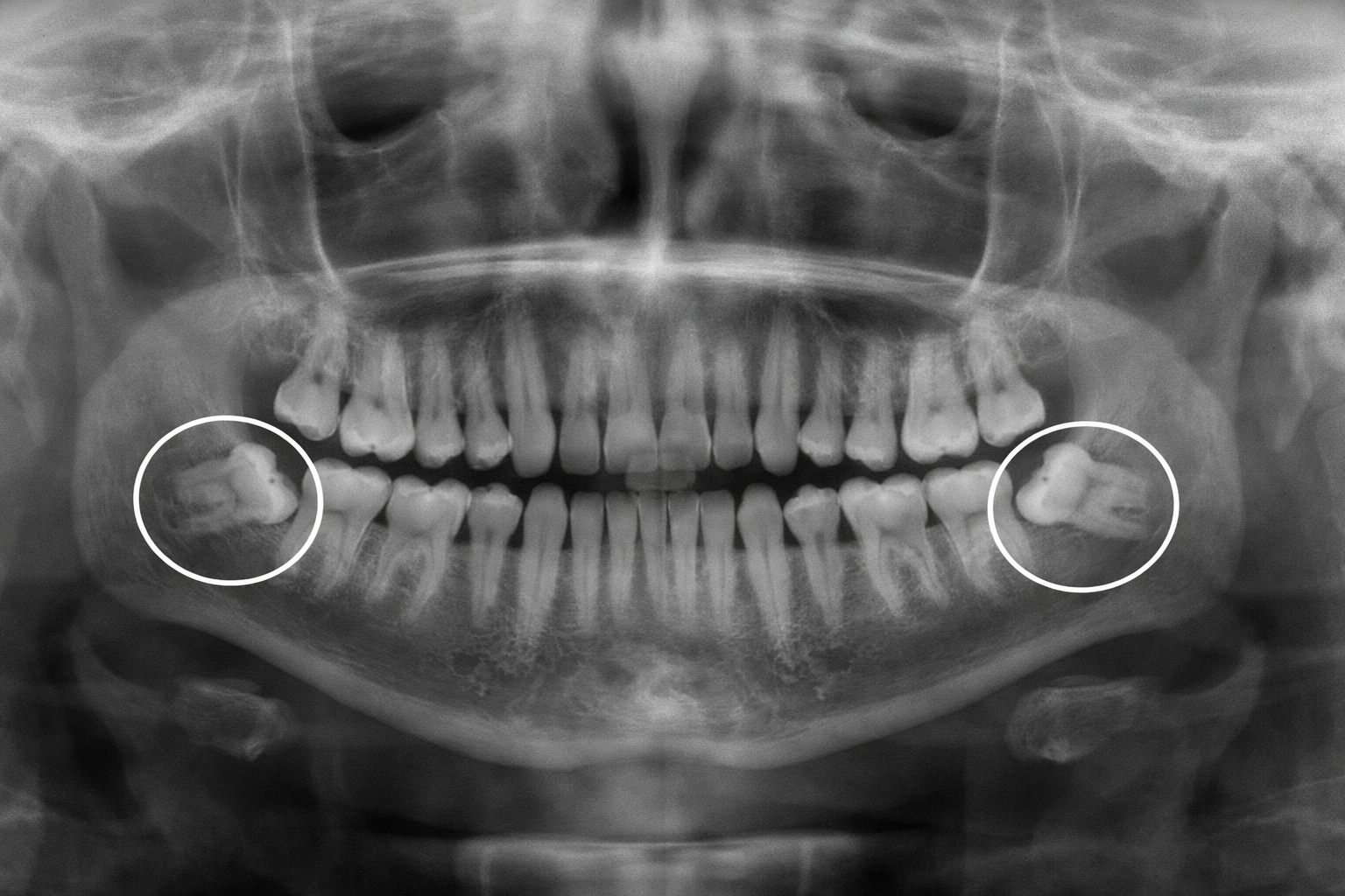 Wisdom Teeth Extraction Illustration
